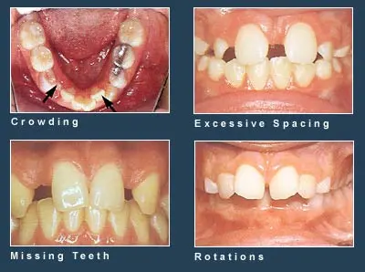 Different types of orthodontic problems Different types of orthodontic problems